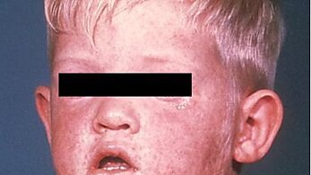 Face of boy after three days with measles rash. Source: CDC.